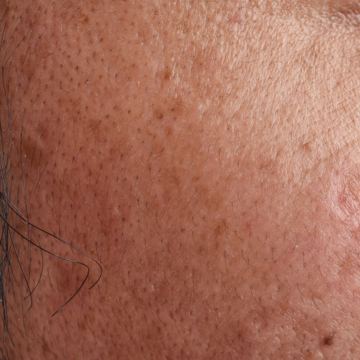HyperPigmentation of the skin