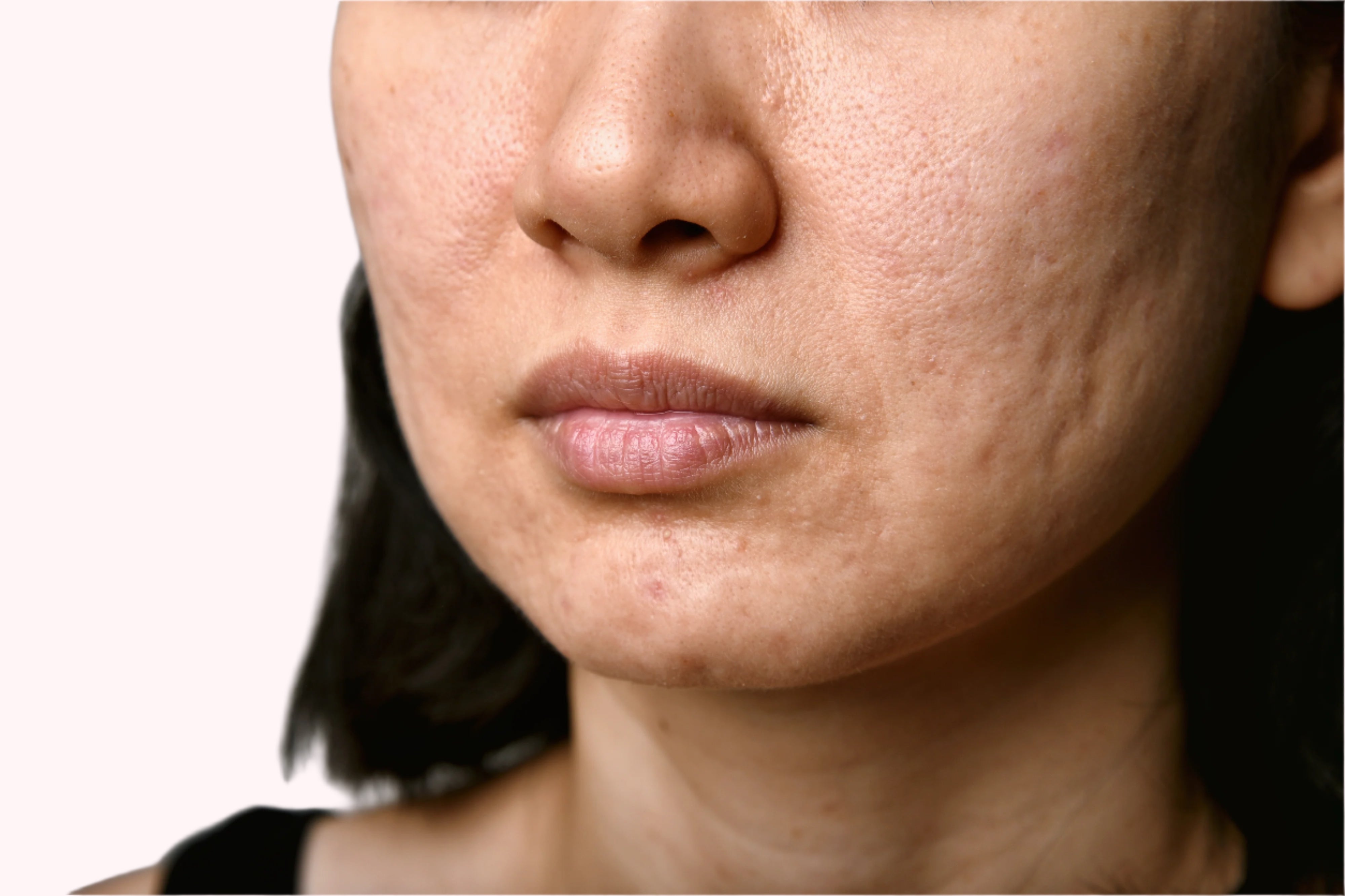 Scarring_and_wound_healing_skin