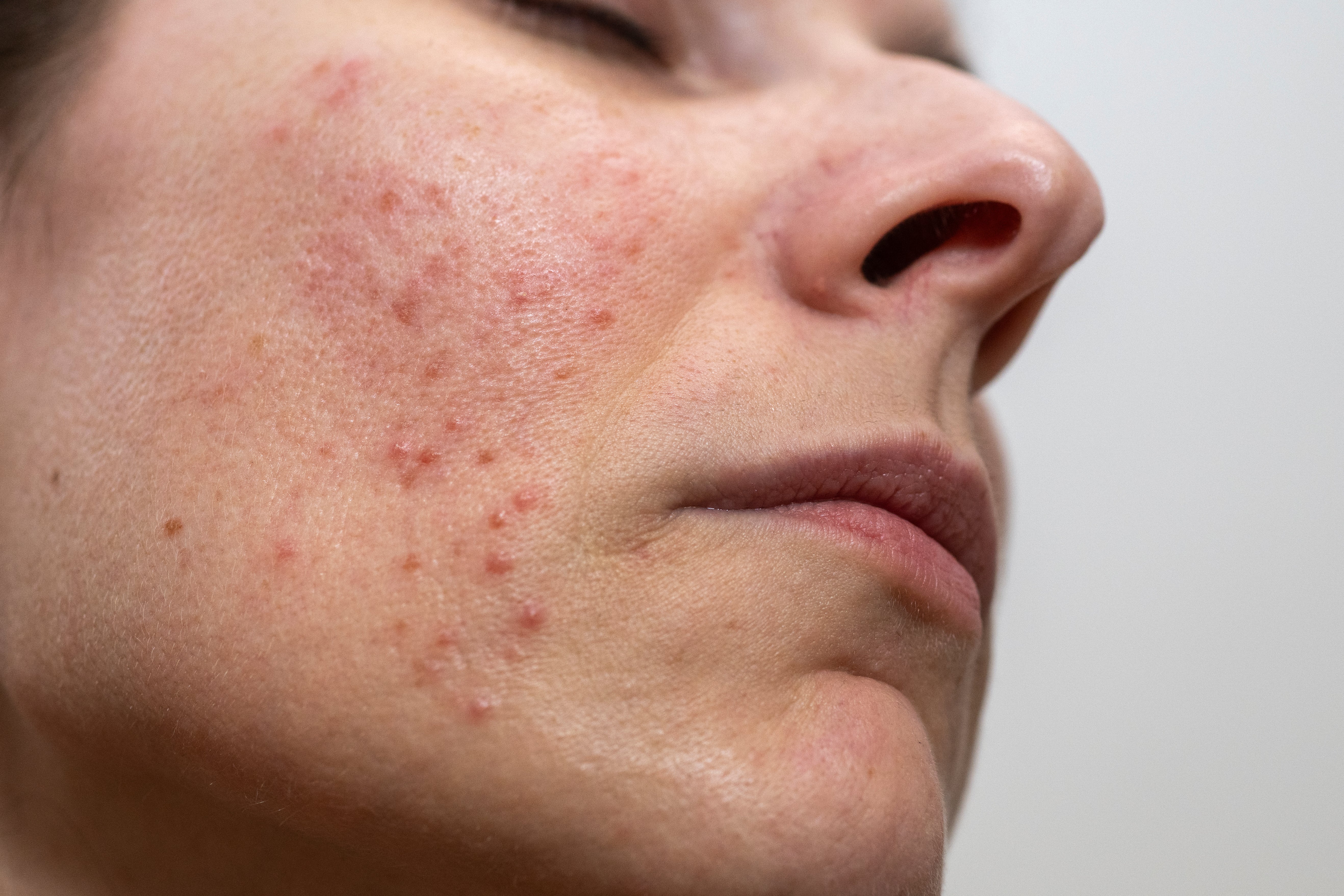 Skin_acne_Psoriasis_rosacea