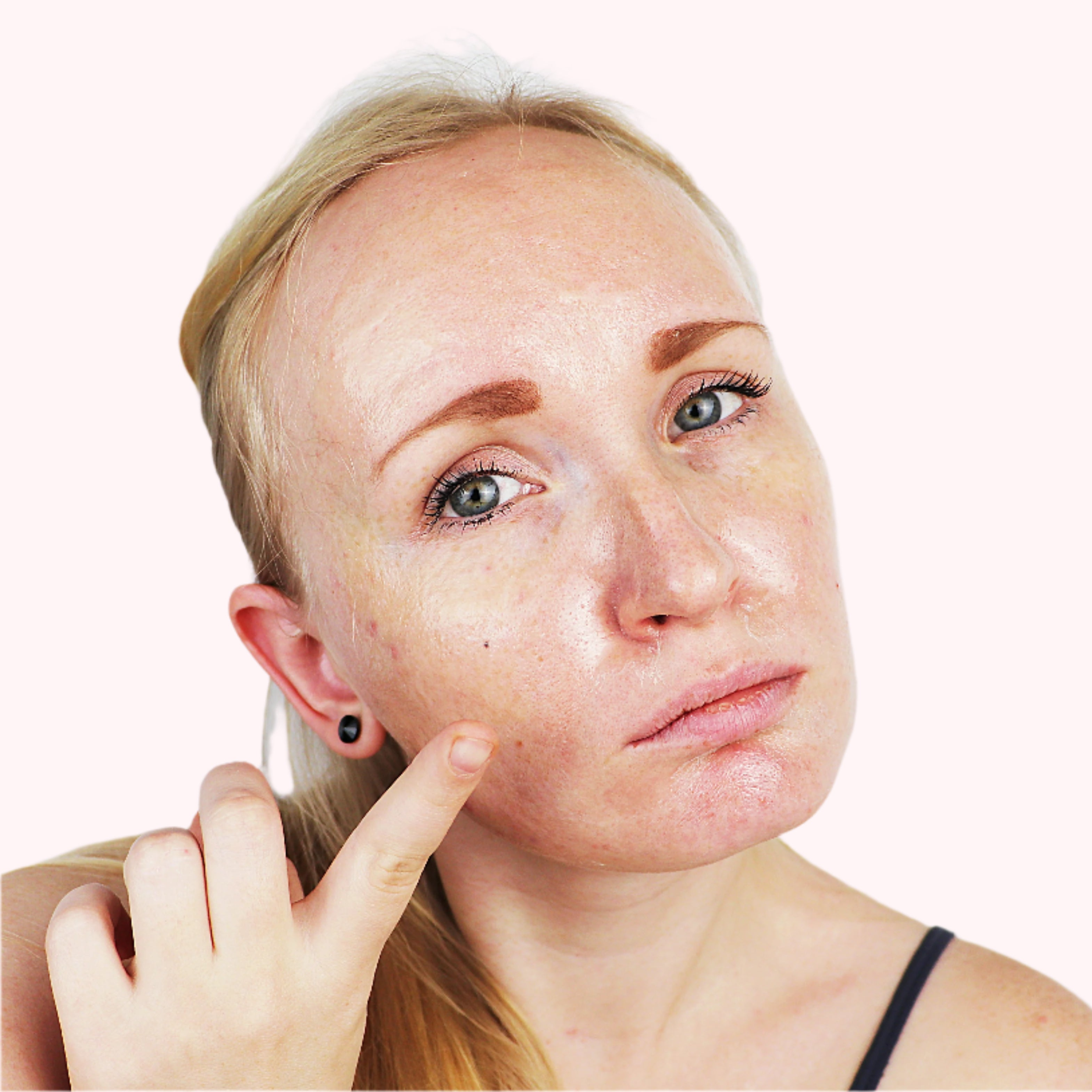 What is Skin Oiliness?