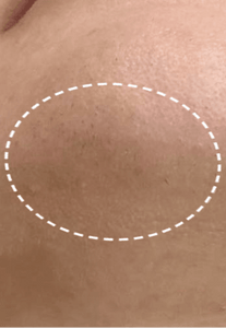 Close-Up of Mave IPL Treatment Results – Chin & Jawline