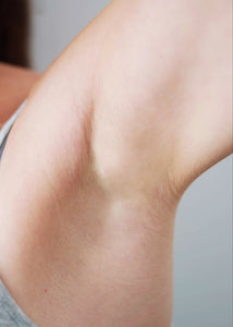 Before and After – Mave IPL Treatment on Underarm