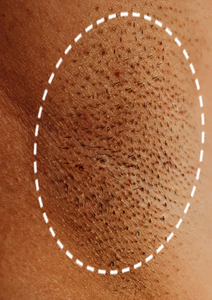 Mave IPL At-Home Laser Results
